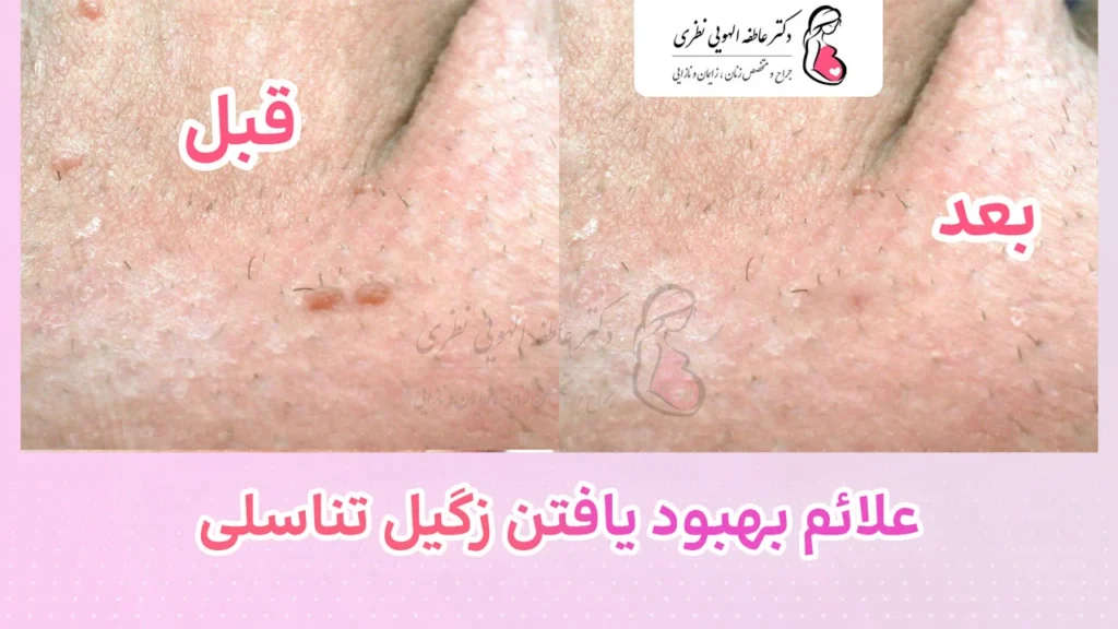 قبل و بعد از درمان زگیل تناسلی