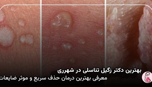 بهترین دکتر زگیل تناسلی در شهرری
