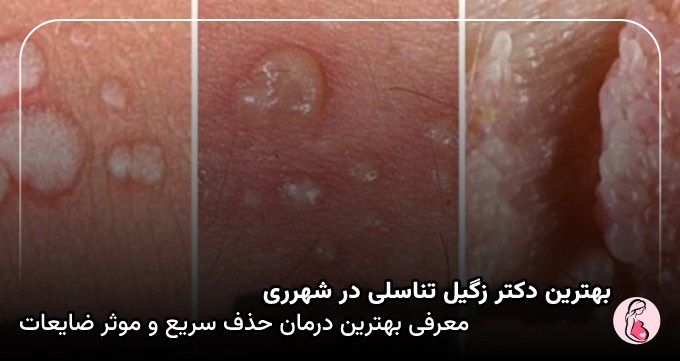 بهترین دکتر زگیل تناسلی در شهرری