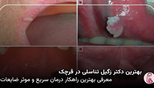بهترین دکتر زگیل تناسلی در قرچک