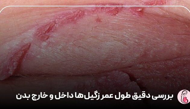 بررسی دقیق طول عمر زگیل‌ها داخل و خارج بدن