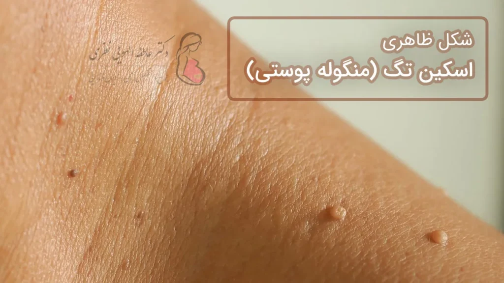 شکل ظاهری اسکین تگ یا منگوله پوستی