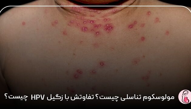 مولوسکوم تناسلی چیست؟ تفاوتش با زگیل HPV چیست؟