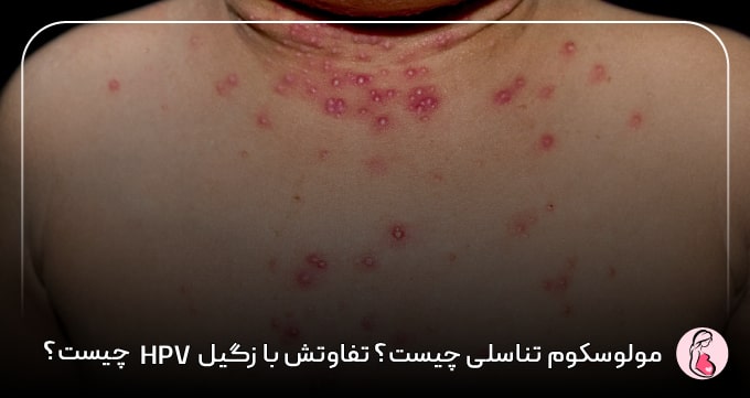 مولوسکوم تناسلی چیست؟ تفاوتش با زگیل HPV چیست؟