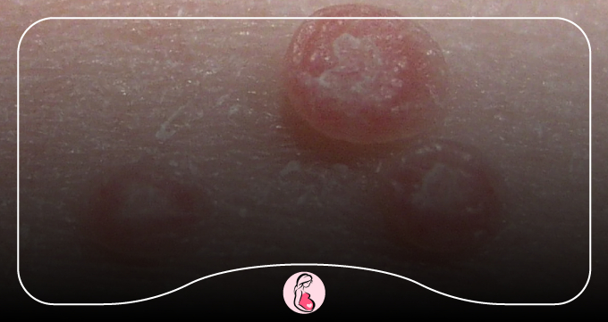 زگیل مسطح (Flat Warts)