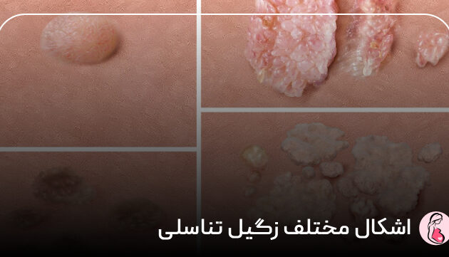 اشکال مختلف زگیل تناسلی