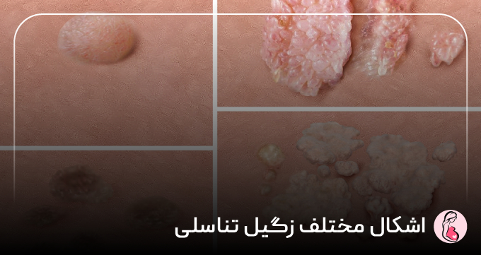 اشکال مختلف زگیل تناسلی